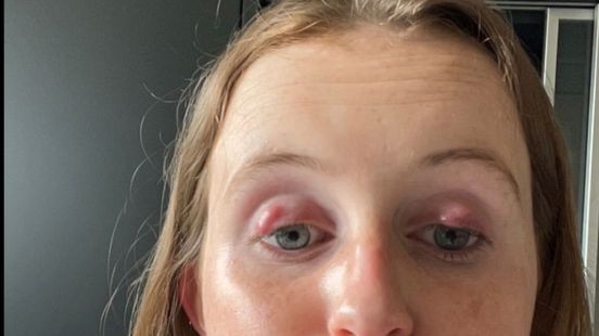 Milou gebruikte drie maanden wimperserum en heeft nu chronisch oogontsteking