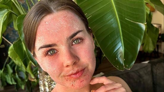 Afkicken van hormoonzalf: Evianne (31) vecht al jaren met én voor haar huid